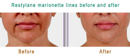 Restylane marionette lines before and after