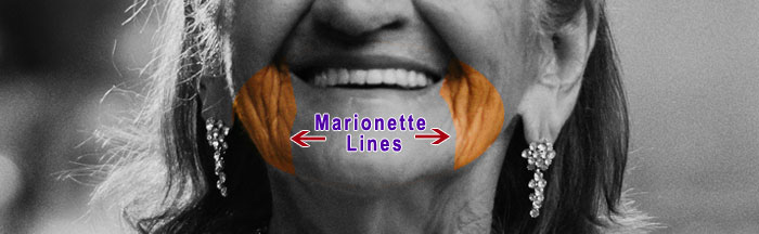 Marionette lines